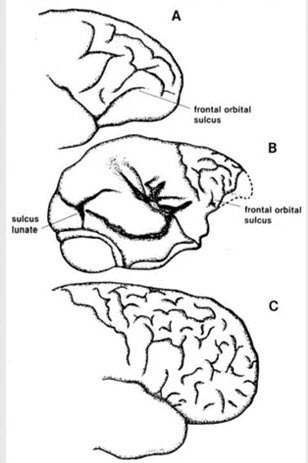 Cerebral Convolutions